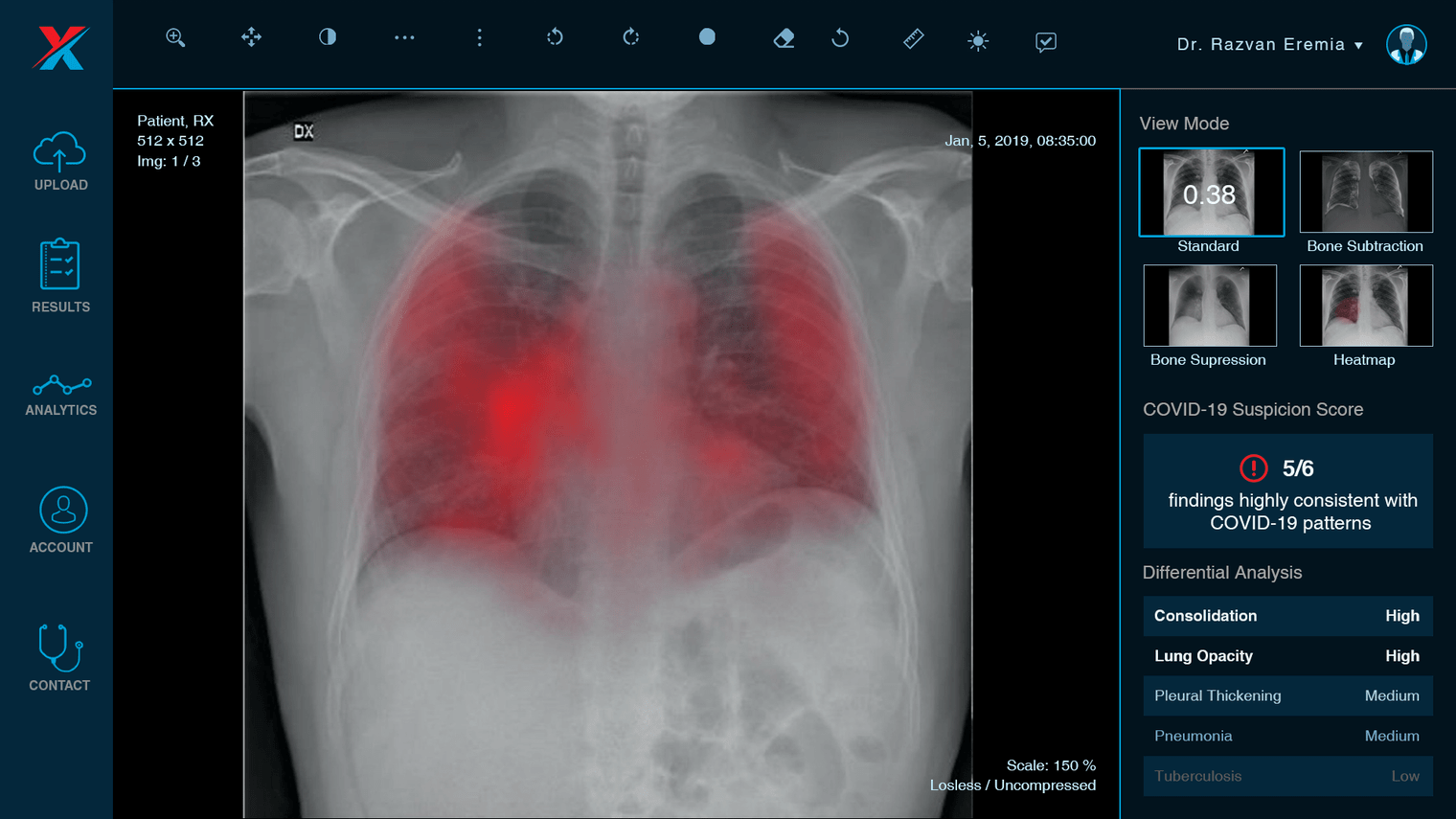 Radiografii pulmonare citite cu inteligență artificială pentru suspecții de COVID-19 din Timișoara ș...