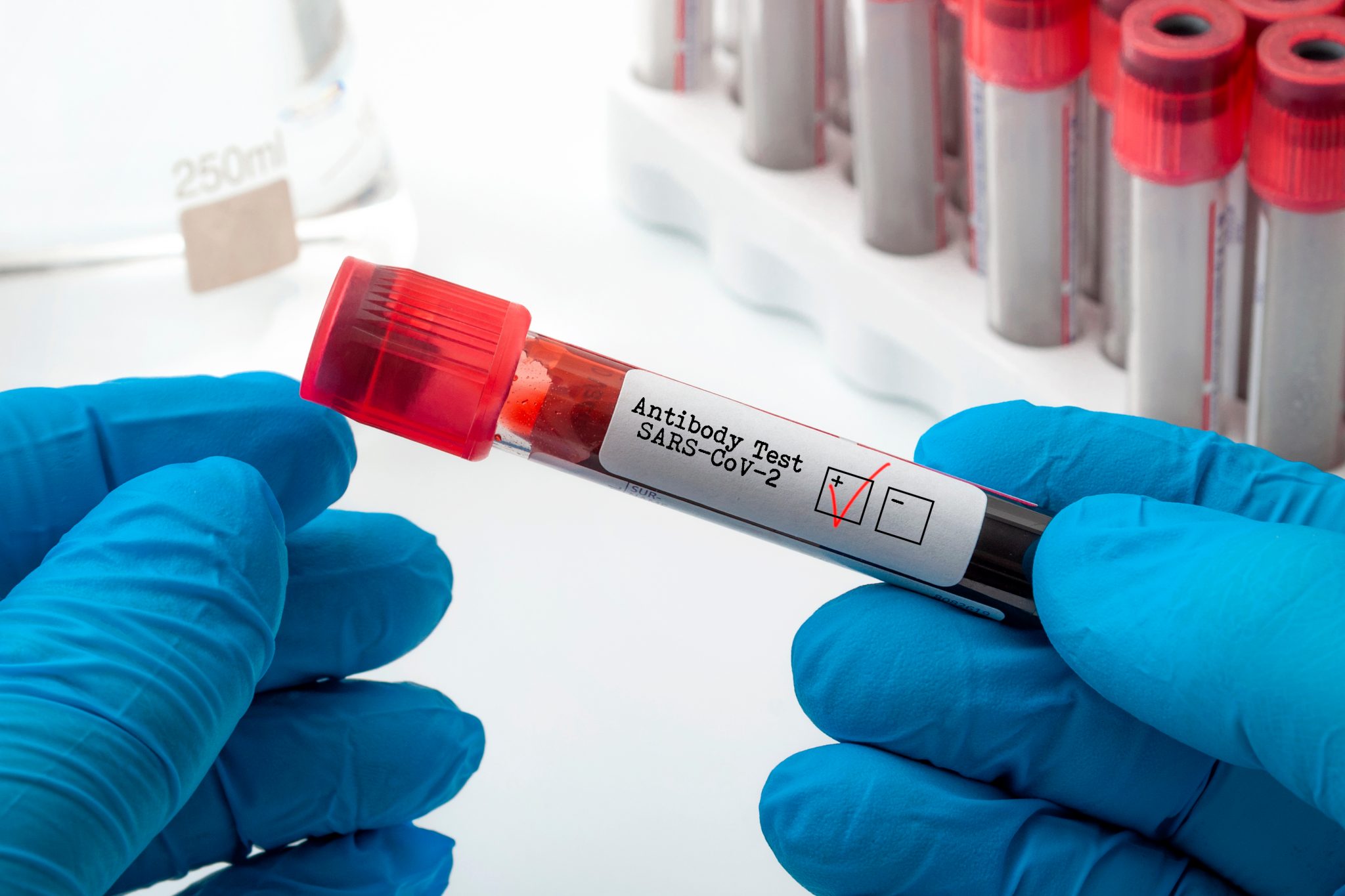 Nu toți pacienții confirmați cu COVID-19 dezvoltă imunitate la virus